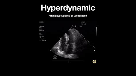 lv lift|hyperdynamic left ventricle treatment.